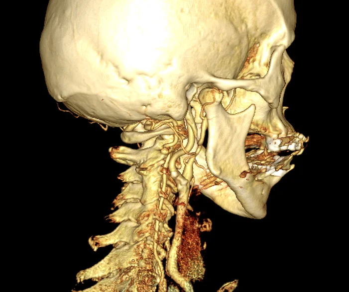 3D-CT-Rekonstruktion des menschlichen Schädels und der Halswirbelsäule in Seitenansicht.