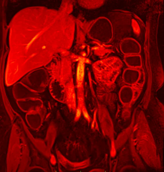 Farbverstärkte MRT-Aufnahme des Oberbauchs mit sichtbarer Leber, Gefäßen und inneren Organen.