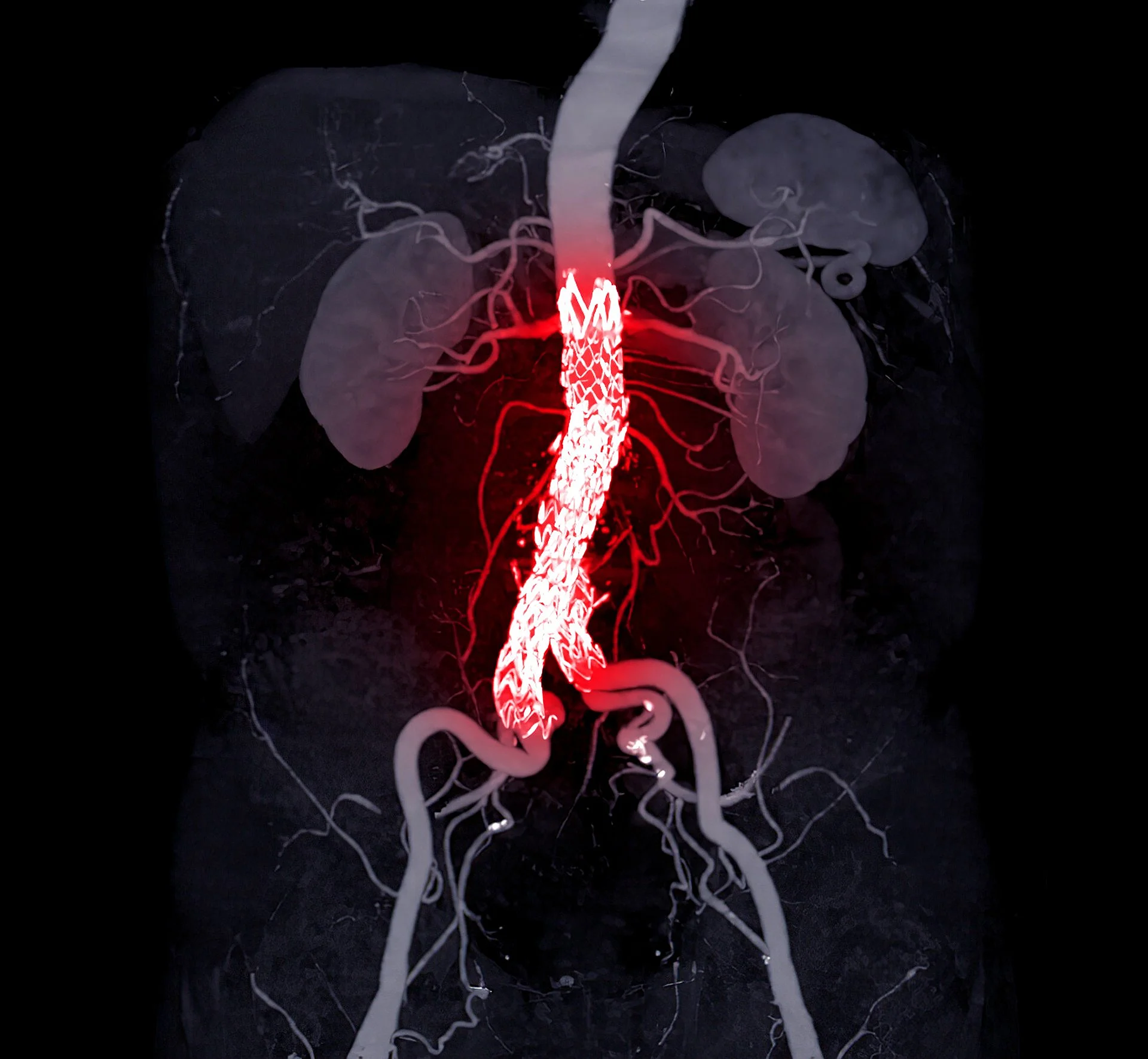 3D-Darstellung der Bauchschlagader mit eingesetztem Stentgraft bei Aneurysma der abdominalen Aorta.