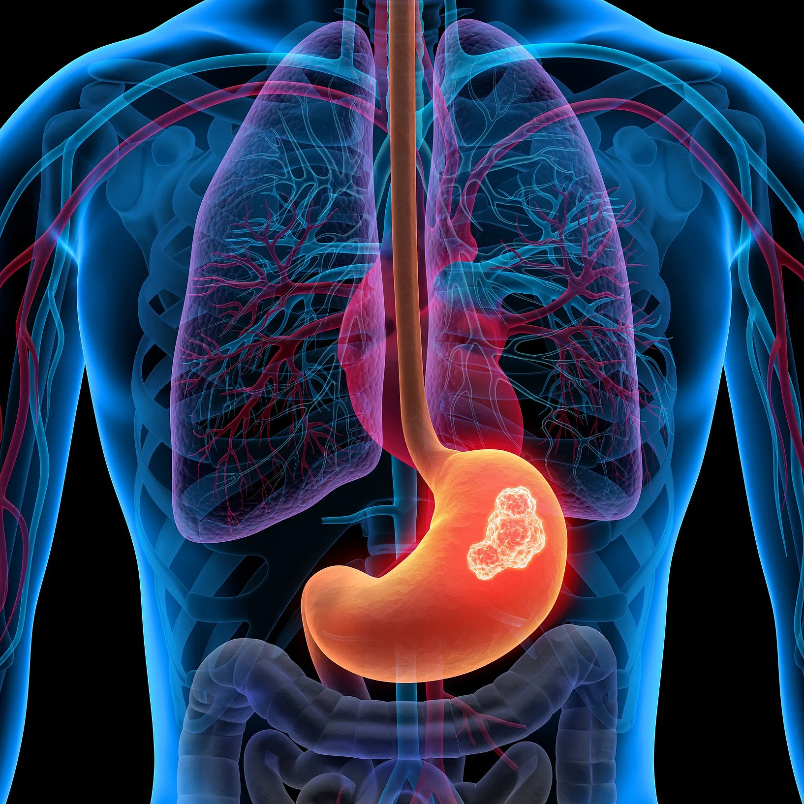 3D-Darstellung des menschlichen Oberkörpers mit hervorgehobenem Magen zur Veranschaulichung gastrointestinaler Tumore.