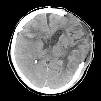 CCT-Weichteilfensterdarstellung nach SHT mit Dekompressionstrepanation (Entfernung des Schädelknochens) links