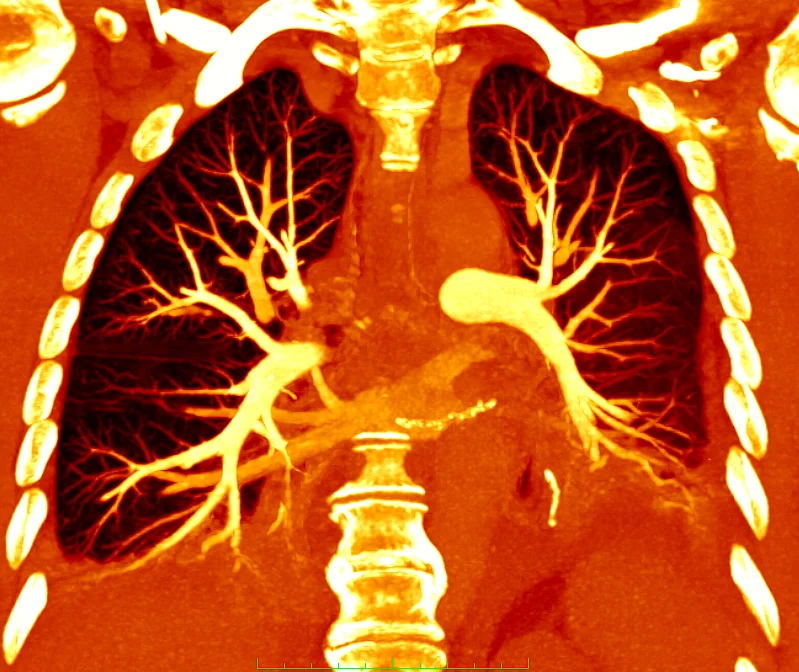 Farbcodierte CT-Angiografie der Lunge mit deutlich sichtbaren Bronchien und Gefäßstrukturen.