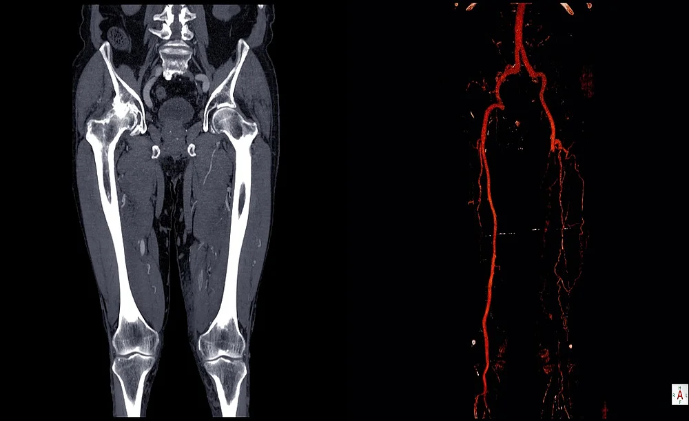 CT-Angiografie-Vergleich der Beinarterien bei peripherer arterieller Verschlusskrankheit (pAVK) mit Kontrastmittel-Darstellung.