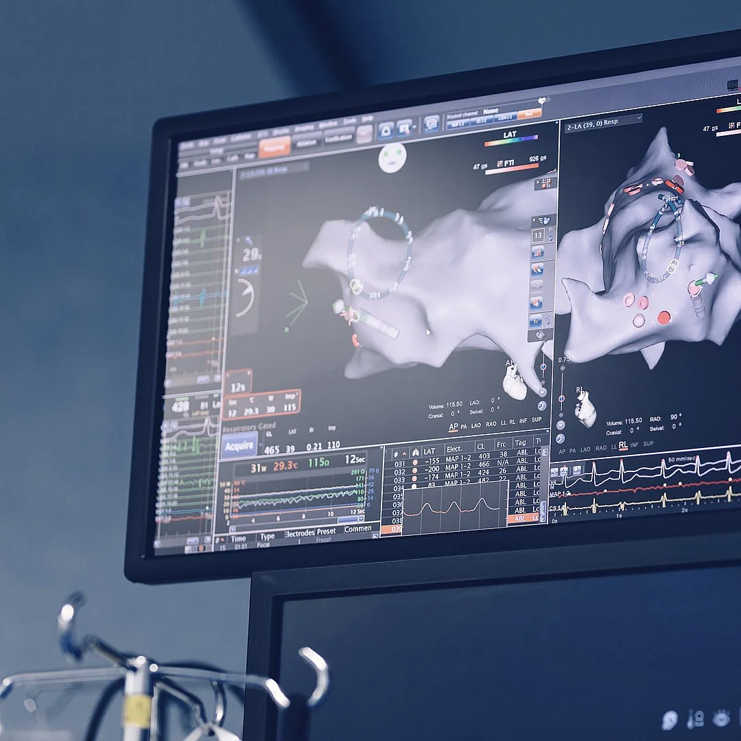 Monitor zeigt radiologisches Bild einer Gefäßdarstellung im Herzkatheterlabor.