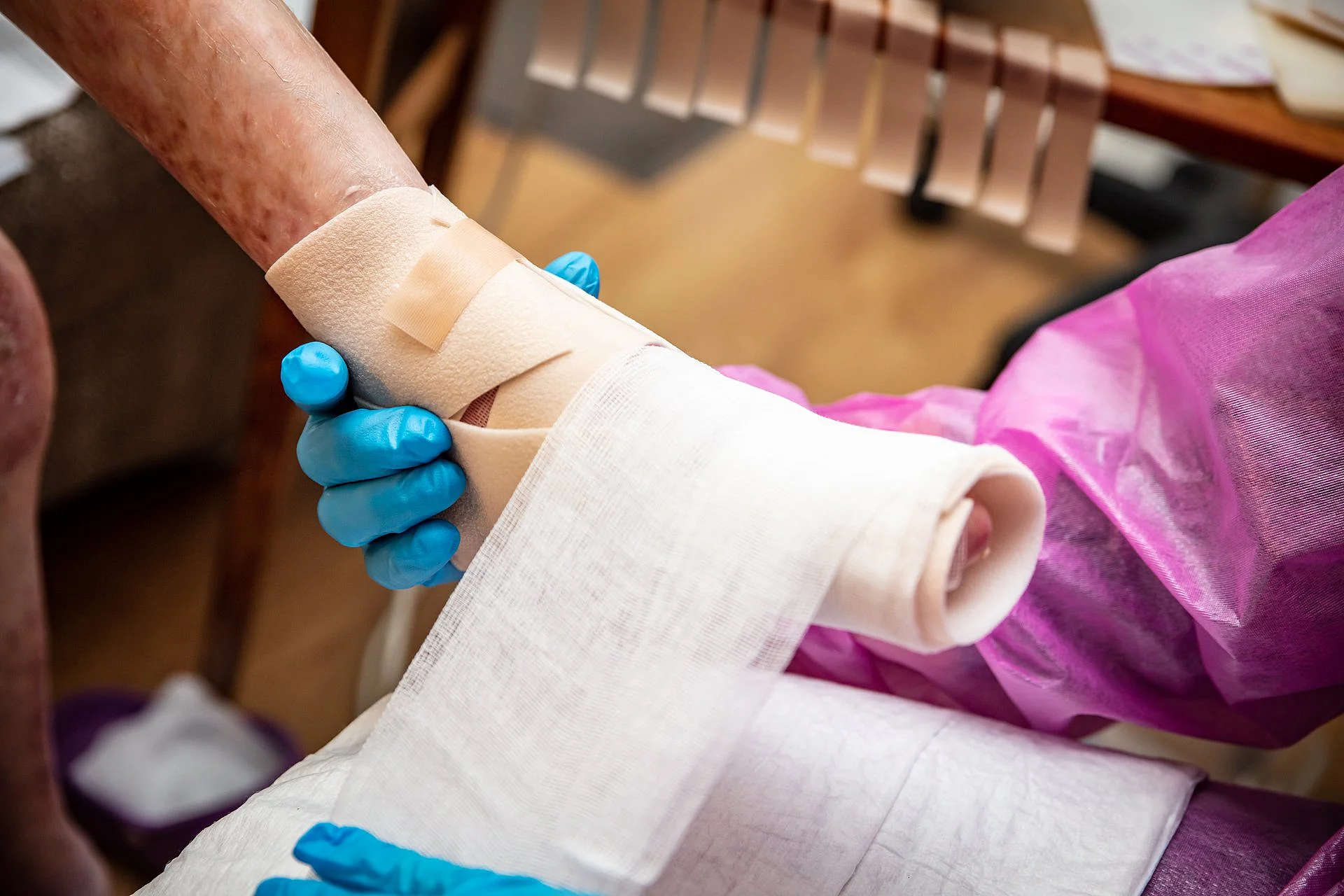 Pflegekraft mit Handschuhen verbindet den verletzten Fuß eines Patienten mit Epidermolysis bullosa sorgfältig mit Mullbinden.