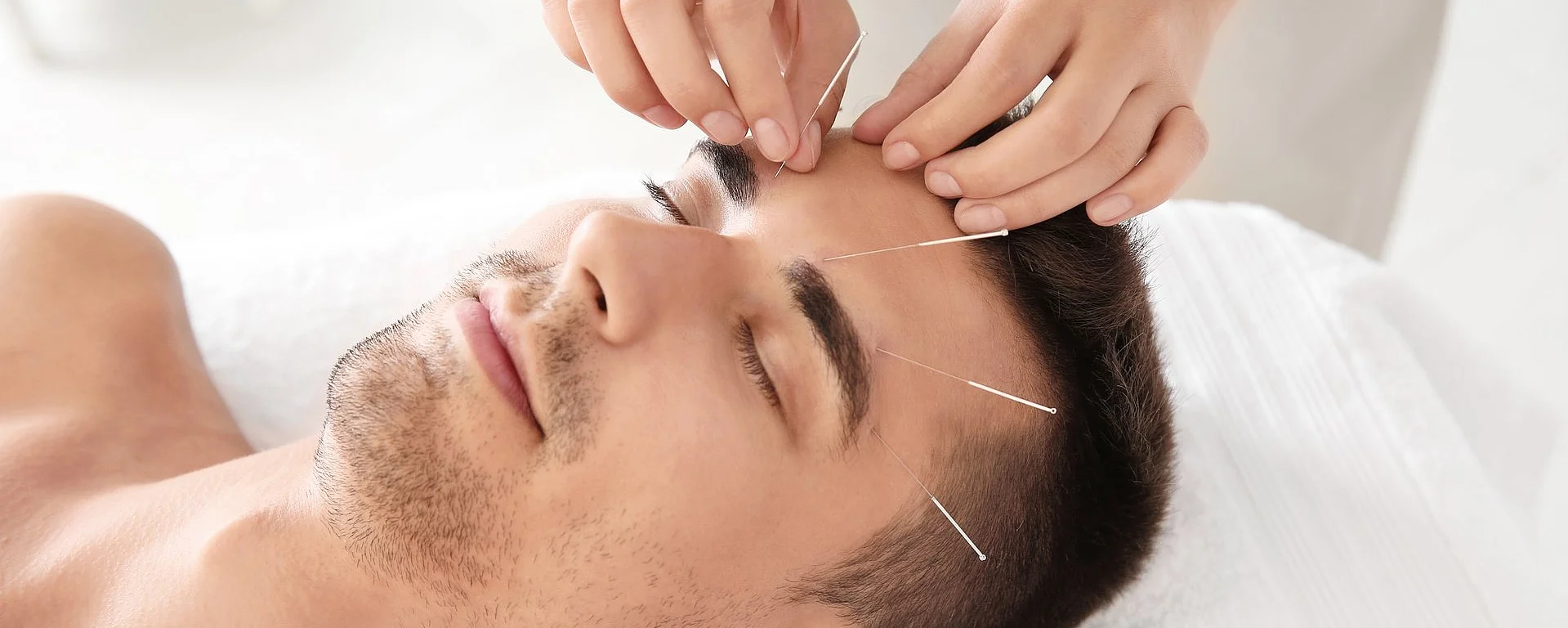 Ein Mann liegt auf einer Liege und wird mit Akupunkturnadeln behandelt.