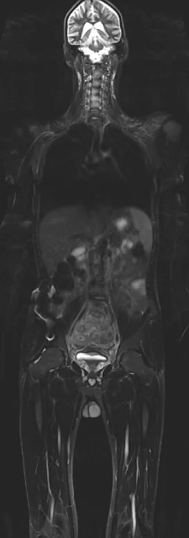 Ganzkörper-MRT in frontaler Ansicht mit Darstellung von Weichteilen, Wirbelsäule und Organen.
