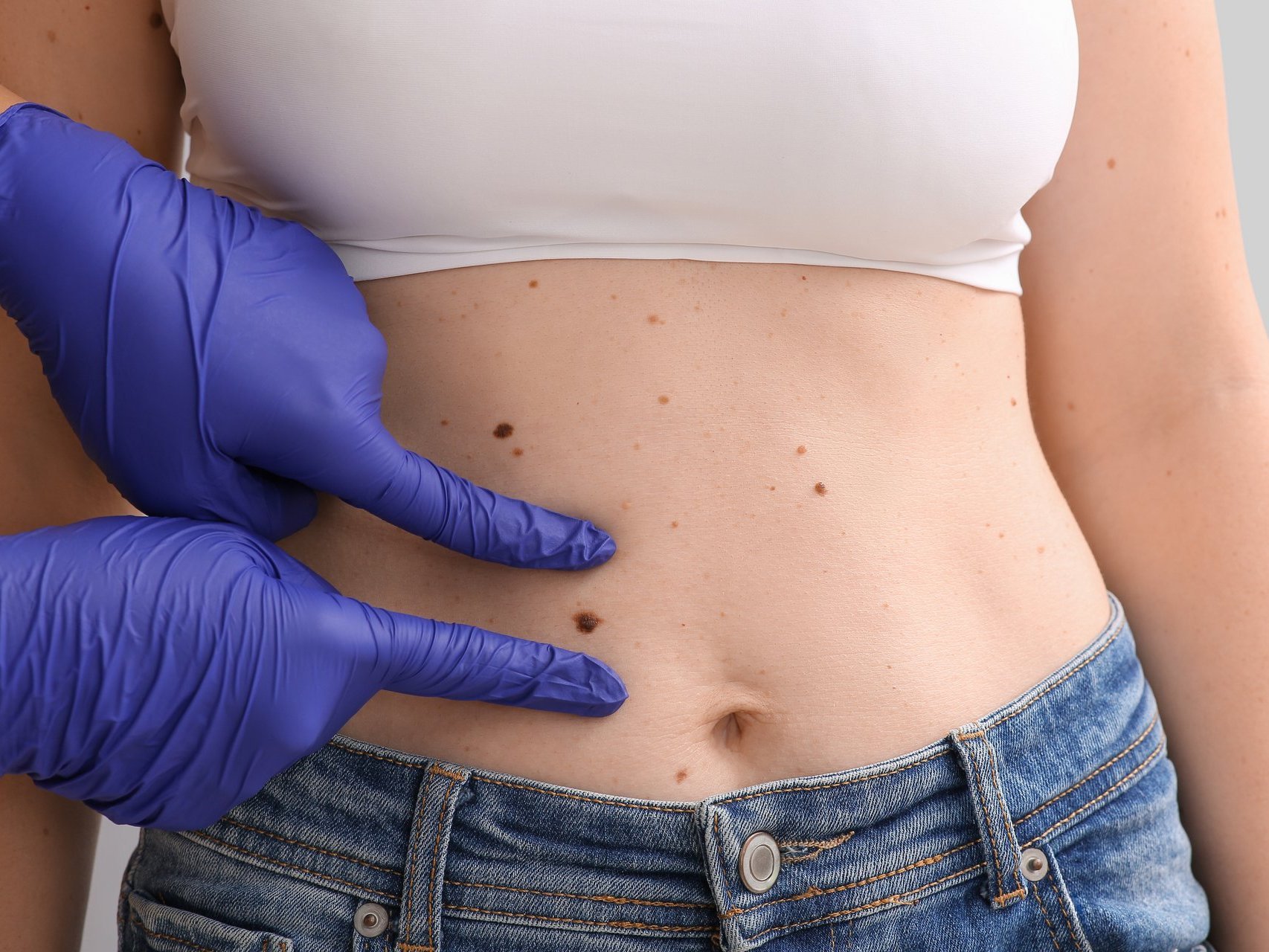 Das Bild zeigt den Bauch einer Frau mit mehreren Muttermalen, auf die eine Person mit violetten Untersuchungshandschuhen zeigt.