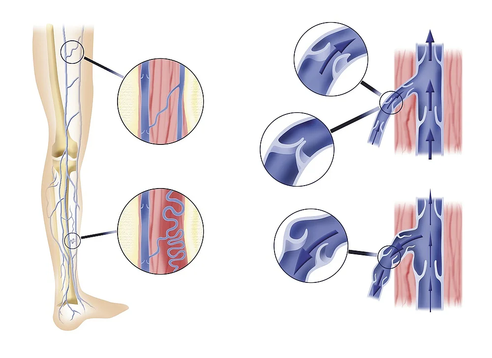 Medizinische Illustration zur Behandlung von Venenleiden mit Darstellung der Beinvene und verschiedenen Therapieverfahren.