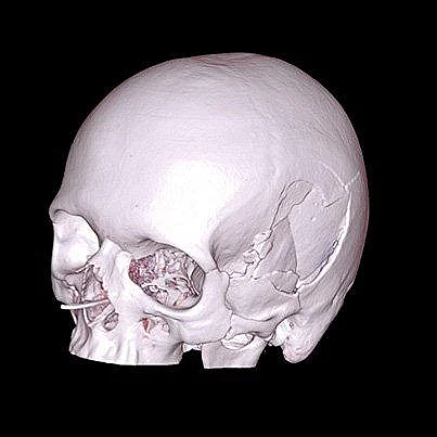 3D CT Rekonstruktion der Impressionsfraktur