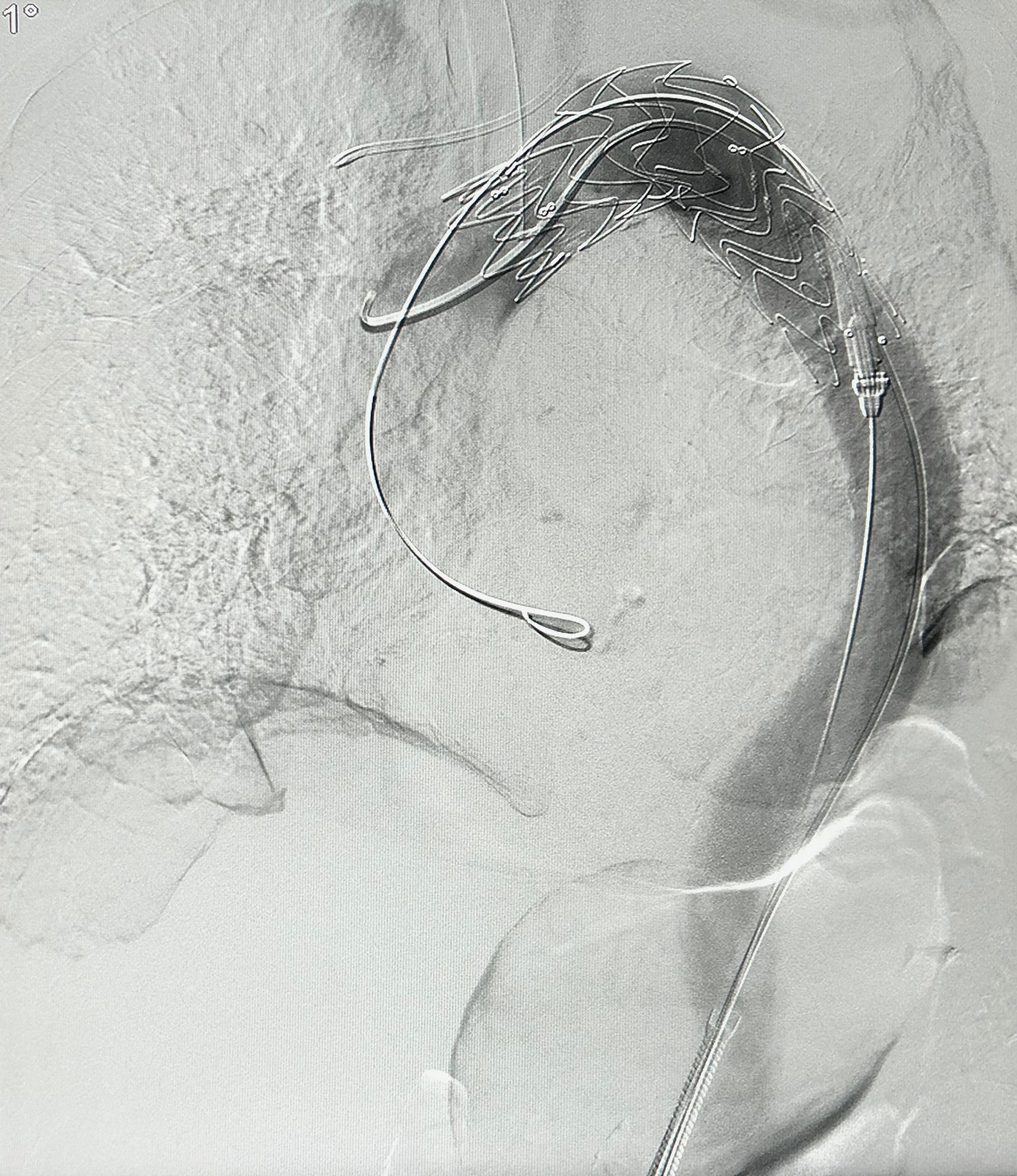 Darstellung einer Stent-Implantation in der interventionellen Radiologie
